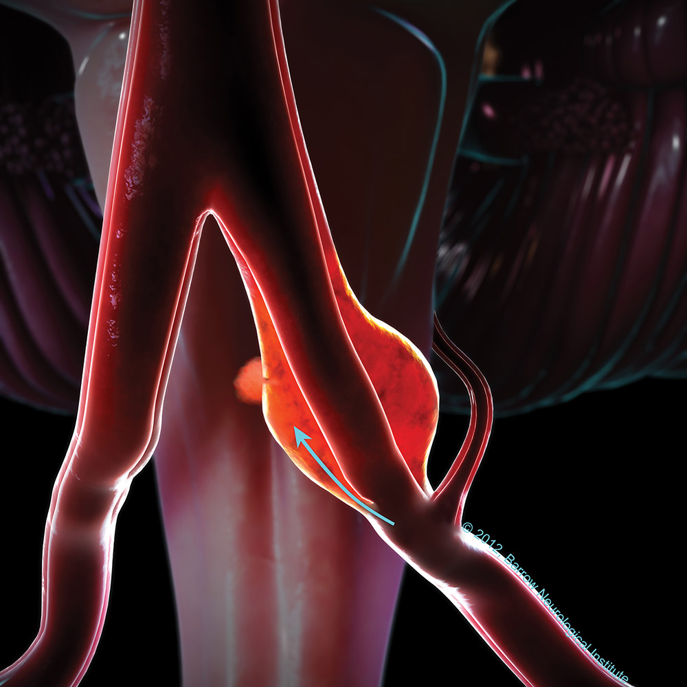 Joe Niekro Foundation - Types of Celebral Aneurysms