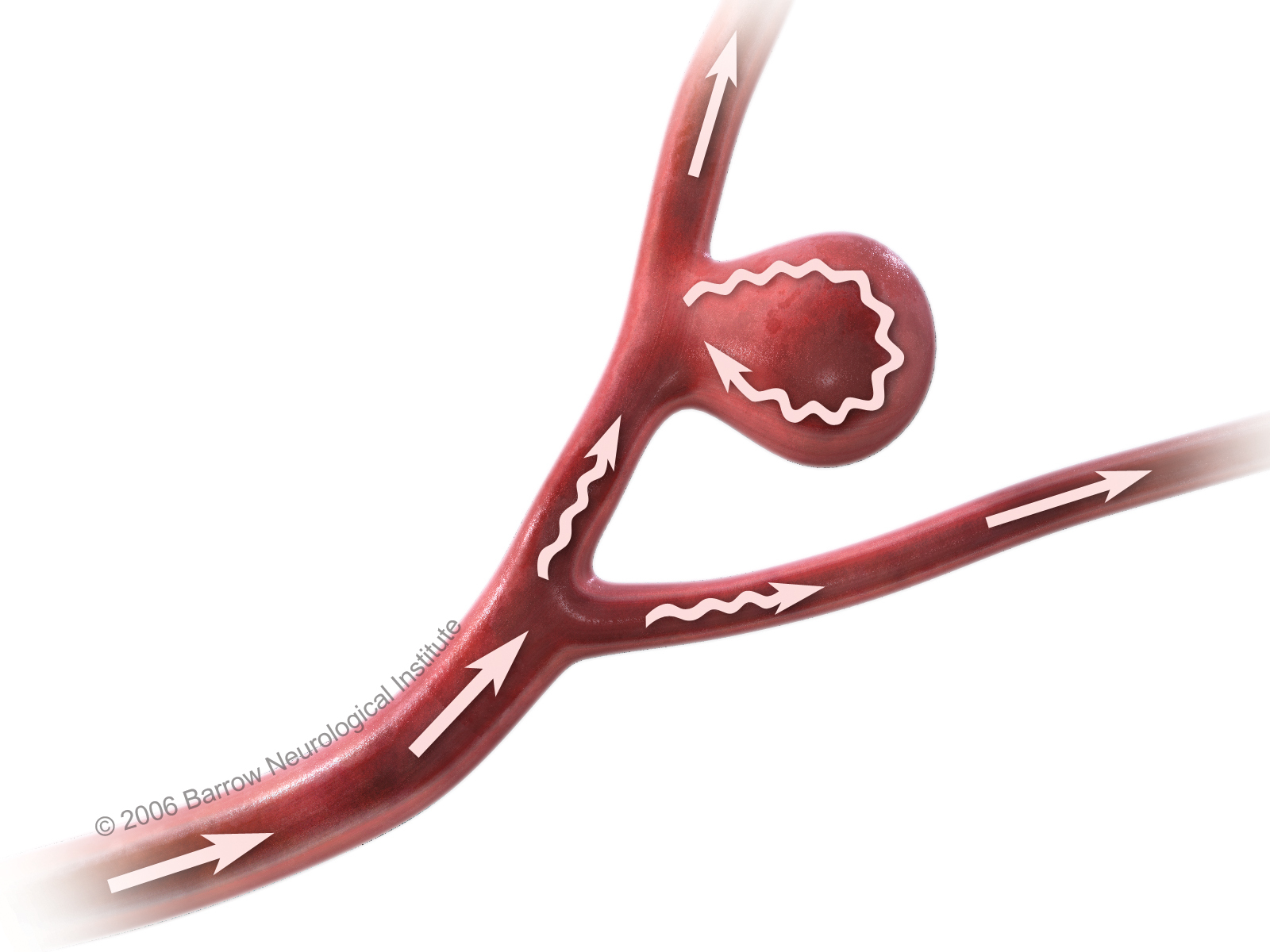 Joe Niekro Foundation - How Does a Brain Aneurysm Develop?