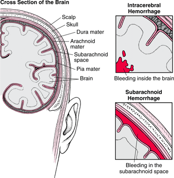 Joe Niekro Foundation - What is a Hemorrhagic Stroke?