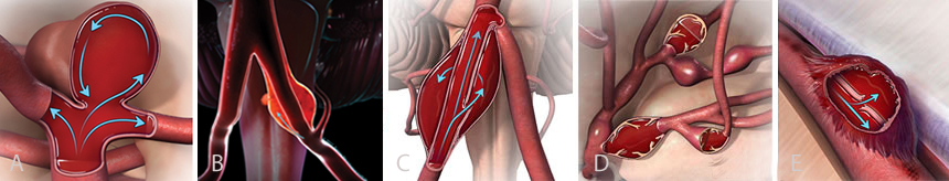 Joe Niekro Foundation - Four Types of Celebral Aneurysms