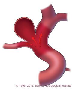 Joe Niekro Foundation - What is an Aneurysm?