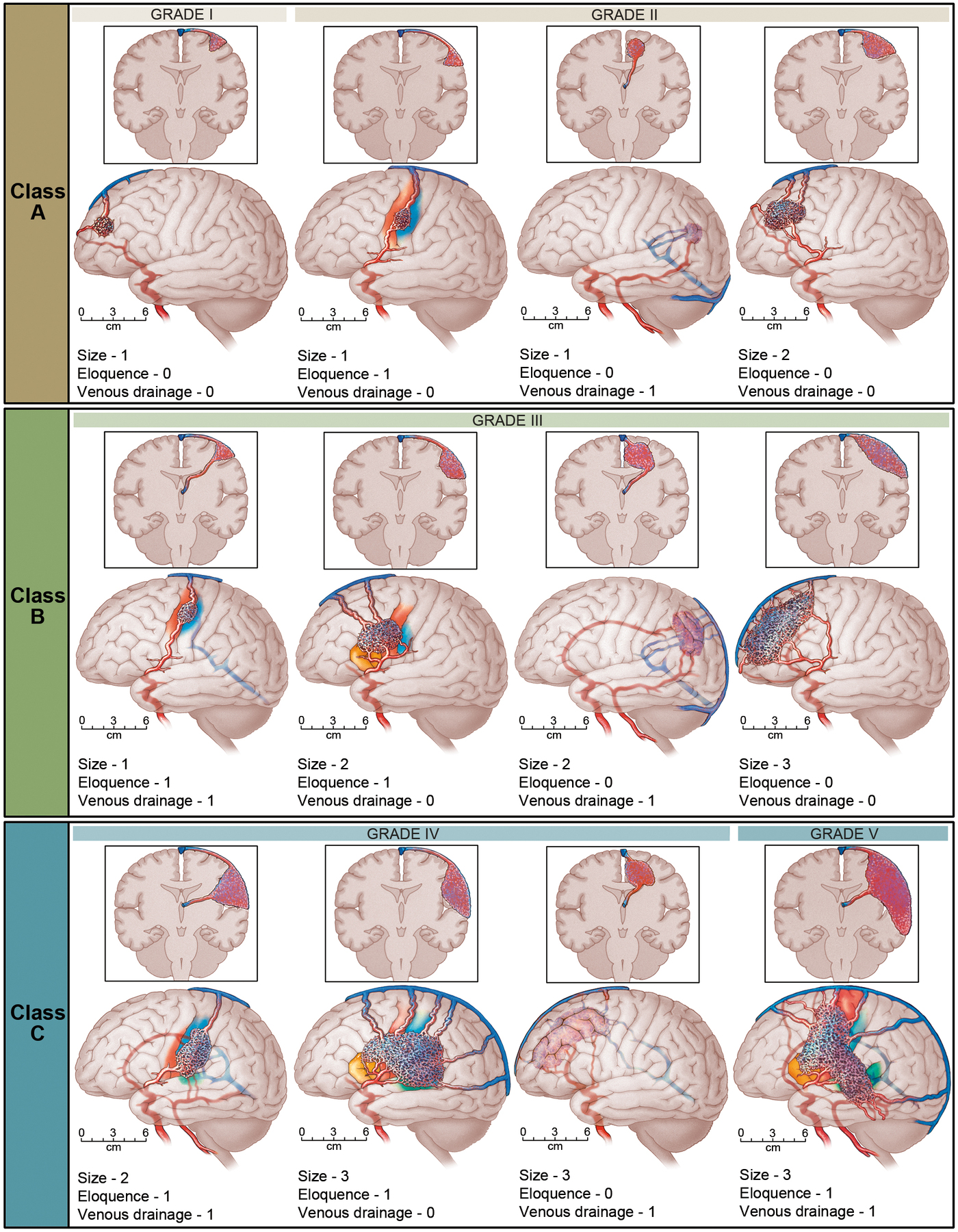 What is an AVM? - The Niekro Aneurysm and AVM Foundation