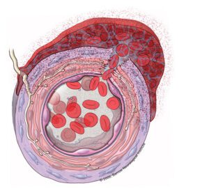 What Happens When an Aneurysm Bleeds?